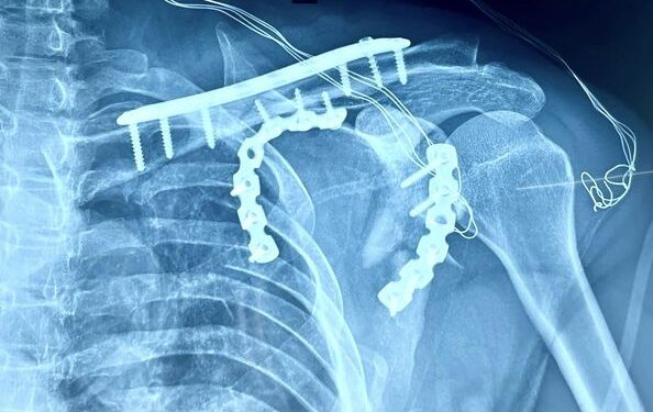 Mổ thành công ca gãy bập bềnh khớp vai tại Bệnh viện Đa khoa tỉnh Khánh Hòa