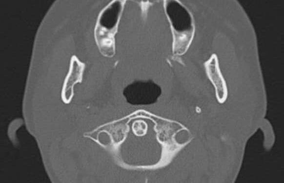 Nang xương hàm do điều trị tủy sai cách – Kẻ phá hủy xương thầm lặng