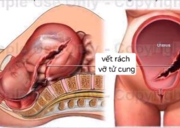 Tiền sử mổ lấy thai nhiều lần – Nguy cơ tiềm tàng trong thai kỳ tiếp theo