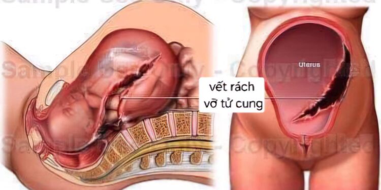 Tiền sử mổ lấy thai nhiều lần – Nguy cơ tiềm tàng trong thai kỳ tiếp theo