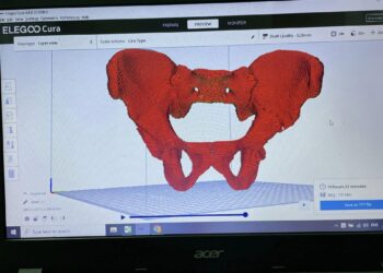 Lần đầu tiên ứng dụng in 3D tái tạo lại khung chậu gãy tại BVĐK tỉnh Khánh Hòa