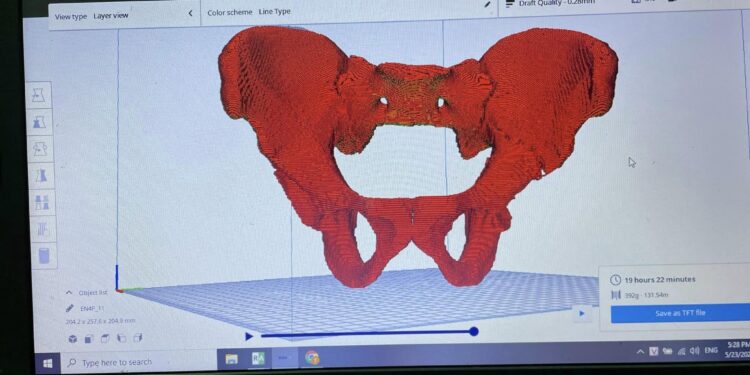 Lần đầu tiên ứng dụng in 3D tái tạo lại khung chậu gãy tại BVĐK tỉnh Khánh Hòa