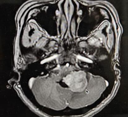 Điều trị phẫu thuật thành công u não Ependymomas tiểu não