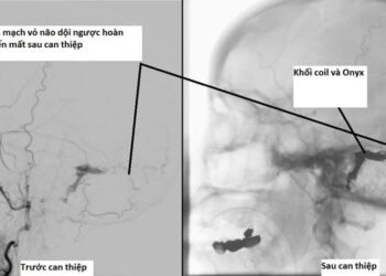 Điều trị thành công rò động tĩnh mạch màng cứng gây xuất huyết não