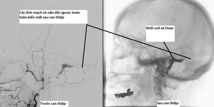 Điều trị thành công rò động tĩnh mạch màng cứng gây xuất huyết não