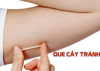 Cấy que tránh thai – Giải pháp ngừa thai hiệu quả và tiện lợi