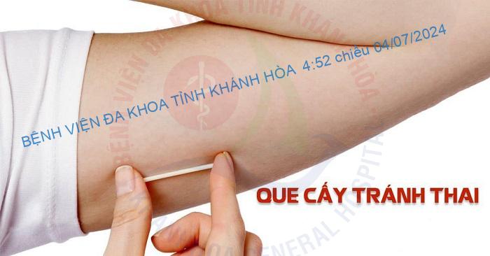 Cấy que tránh thai – Giải pháp ngừa thai hiệu quả và tiện lợi