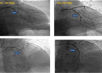 Nỗ lực cứu sống bệnh nhân ngưng tim do nhồi máu cơ tim cấp