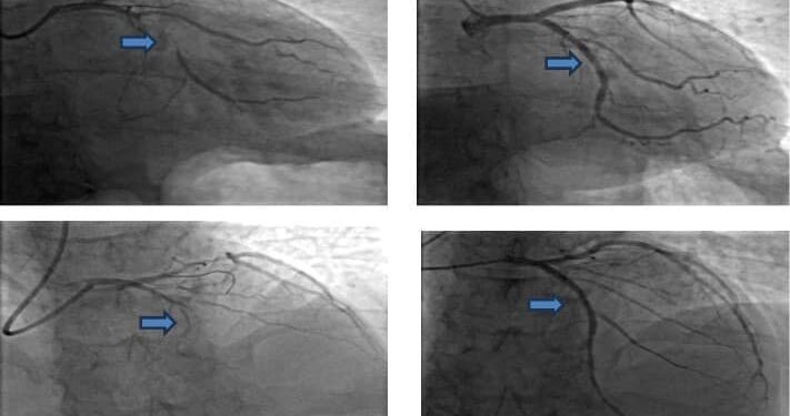 Nỗ lực cứu sống bệnh nhân ngưng tim do nhồi máu cơ tim cấp