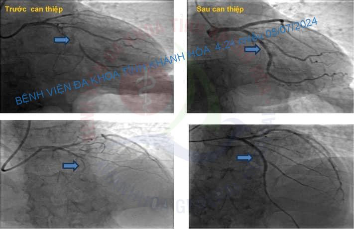 Nỗ lực cứu sống bệnh nhân ngưng tim do nhồi máu cơ tim cấp