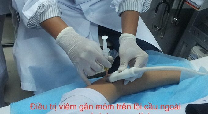 Huyết tương giàu tiểu cầu và hiệu quả điều trị trên hệ cơ xương khớp