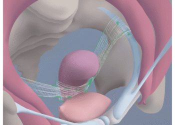 Phẫu thuật nội soi cố định tử cung vào dải chậu lược hai bên