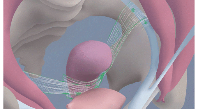 Phẫu thuật nội soi cố định tử cung vào dải chậu lược hai bên