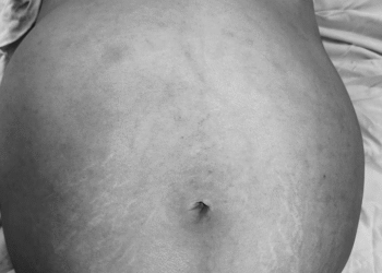 Ung thư buồng trứng – Tầm soát sớm, hi vọng cao