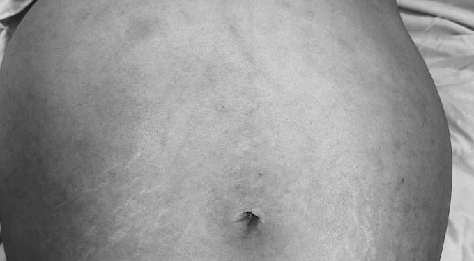 Ung thư buồng trứng – Tầm soát sớm, hi vọng cao