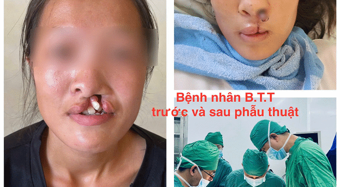 Chuyển giao kỹ thuật điều trị khe hở môi, vòm miệng