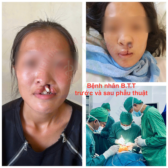 Chuyển giao kỹ thuật điều trị khe hở môi, vòm miệng