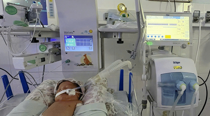 Thở máy rung tần số cao – Cứu tinh cho trẻ sơ sinh suy hô hấp