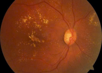 Đừng để tiểu đường “cướp đi” ánh sáng của bạn!