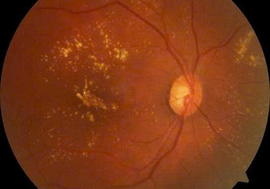 Đừng để tiểu đường “cướp đi” ánh sáng của bạn!