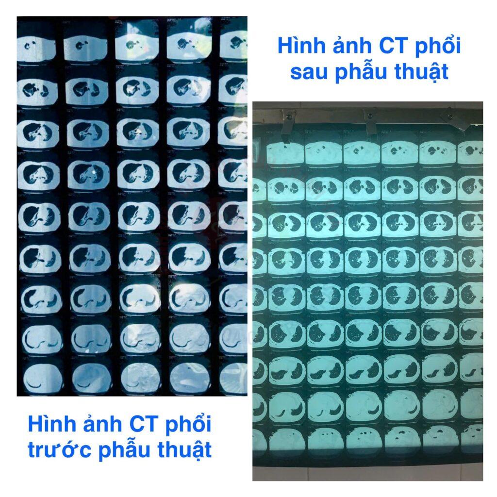 phẫu thuật nội soi ít xâm lấn
phẫu thuật nội soi lồng ngực
điều trị bệnh phổi và màng phổi
phẫu thuật ít xâm lấn tại Bệnh viện Khánh Hòa
phẫu thuật điều trị tràn khí màng phổi
kỹ thuật VATS
