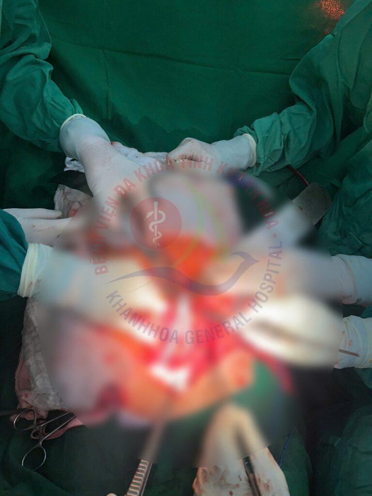 vỡ phình động mạch chủ bụng phình động mạch chủ bệnh viện đa khoa khánh hòa triệu chứng phình động mạch chủ điều trị phình động mạch chủ