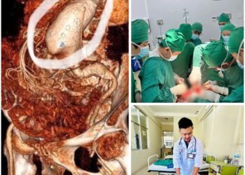 Phẫu thuật cứu sống kịp thời bệnh nhân 86 tuổi vỡ phình động mạch chủ bụng