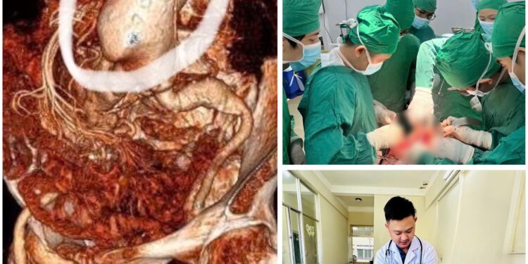 Phẫu thuật cứu sống kịp thời bệnh nhân 86 tuổi vỡ phình động mạch chủ bụng