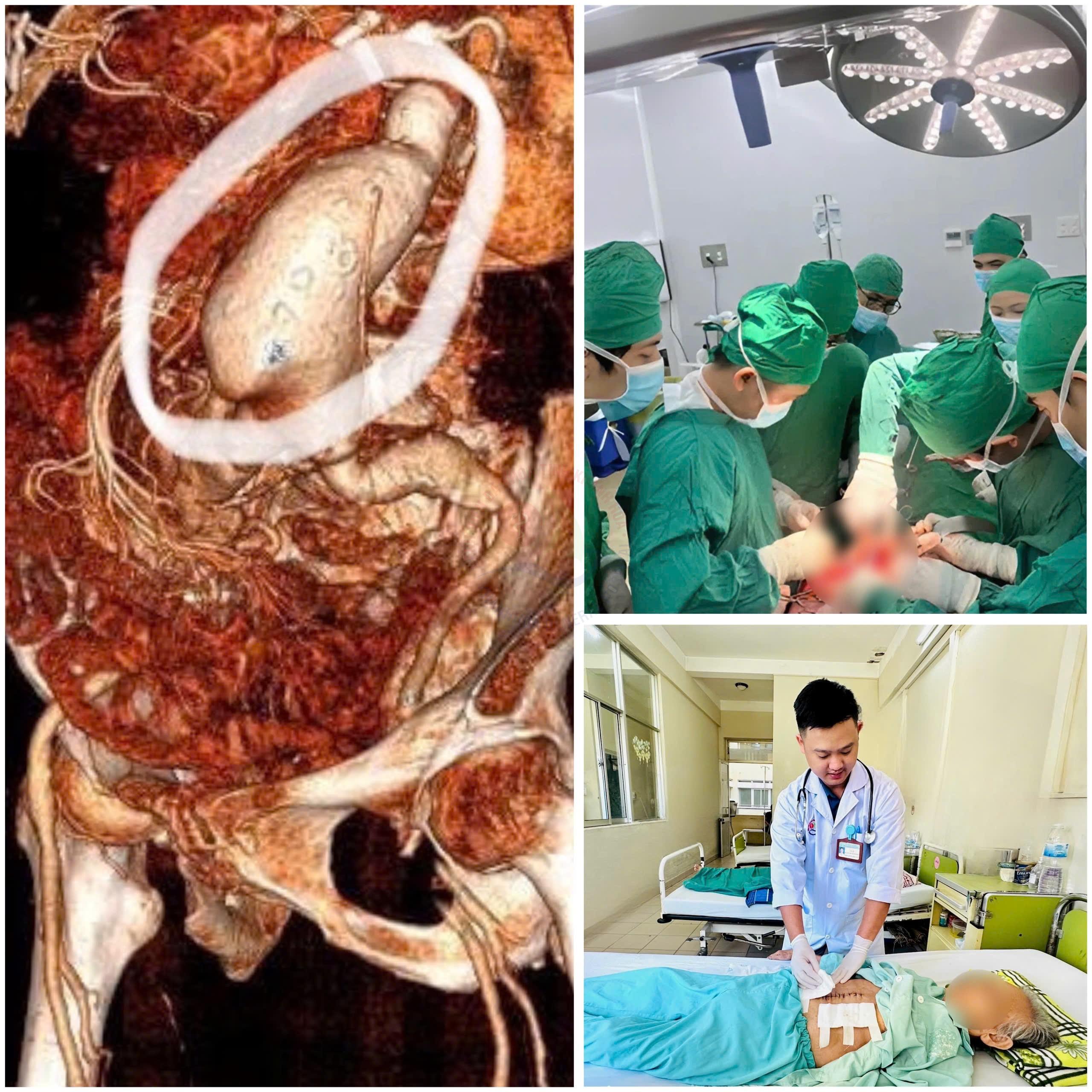 Phẫu thuật cứu sống kịp thời bệnh nhân 86 tuổi vỡ phình động mạch chủ bụng