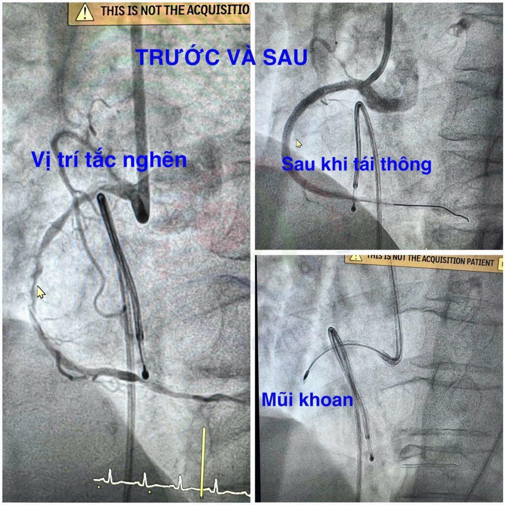 can thiệp mạch vành Bệnh viện Đa khoa Khánh Hòa xơ vữa động mạch bệnh mạch vành kỹ thuật Rotational Atherectomy khám tim mạch