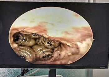 Sốc: Giòi làm tổ trong tai bệnh nhân – Cảnh báo cực kỳ quan trọng về vệ sinh và chăm sóc người thân!