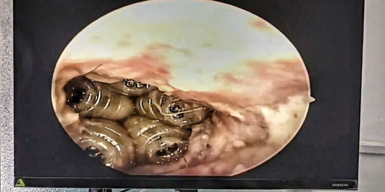 Sốc: Giòi làm tổ trong tai bệnh nhân – Cảnh báo cực kỳ quan trọng về vệ sinh và chăm sóc người thân!