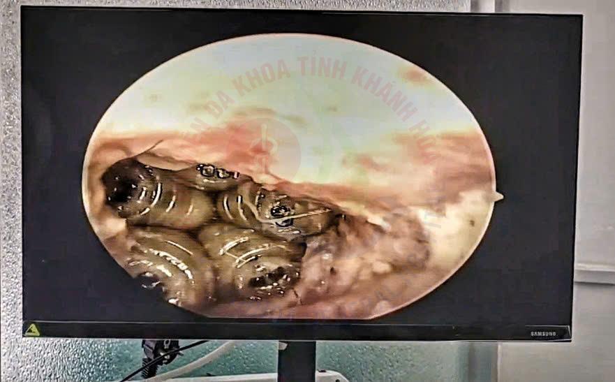 giòi làm tổ trong tai vệ sinh tai otomyiasis đau tai chảy dịch bệnh viện đa khoa khánh hòa