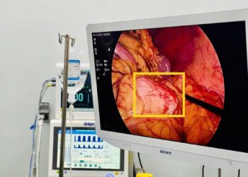 U thân – đuôi tụy: phẫu thuật nội soi cắt thân – đuôi tụy bảo tồn lách hiệu quả điều trị cao