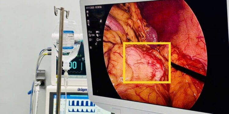 U thân – đuôi tụy: phẫu thuật nội soi cắt thân – đuôi tụy bảo tồn lách hiệu quả điều trị cao