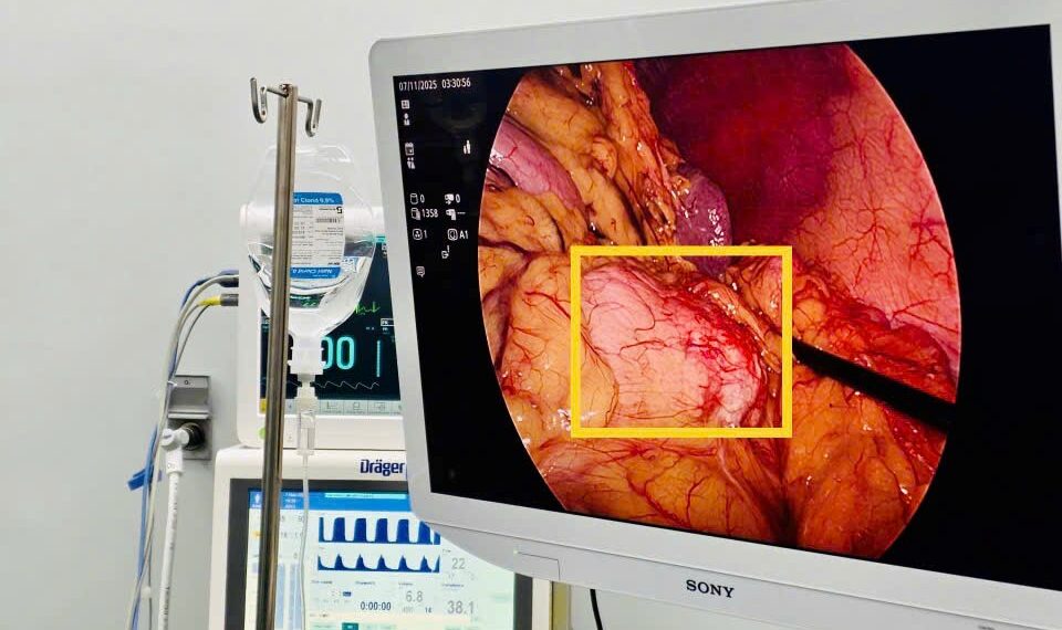 U thân – đuôi tụy: phẫu thuật nội soi cắt thân – đuôi tụy bảo tồn lách hiệu quả điều trị cao