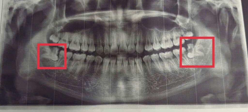 nhổ răng khôn quy trình nhổ răng khôn