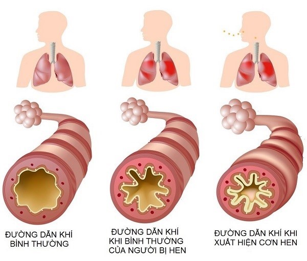 Bệnh Hen Suyễn Điều trị hen suyễn hen suyễn giao mùa dấu hiệu cơn hen cấp phòng khám Hen - COPD Khánh Hòa