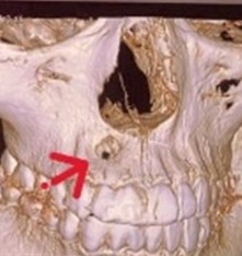 Nang răng Điều trị nang răng tiêu xương hàm phẫu thuật nang răng nha khoa Khánh Hòa CT 128 dãy