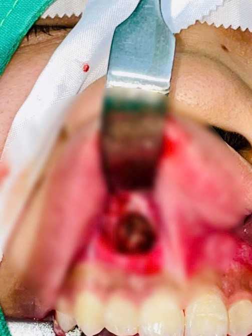 Nang răng Điều trị nang răng tiêu xương hàm phẫu thuật nang răng nha khoa Khánh Hòa CT 128 dãy