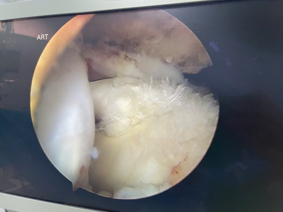 Khâu Rách Chóp Xoay Rách chóp xoay vai phẫu thuật nội soi khớp vai kỹ thuật Double-Row Trung tâm Chấn thương Chỉnh hình Khánh Hòa