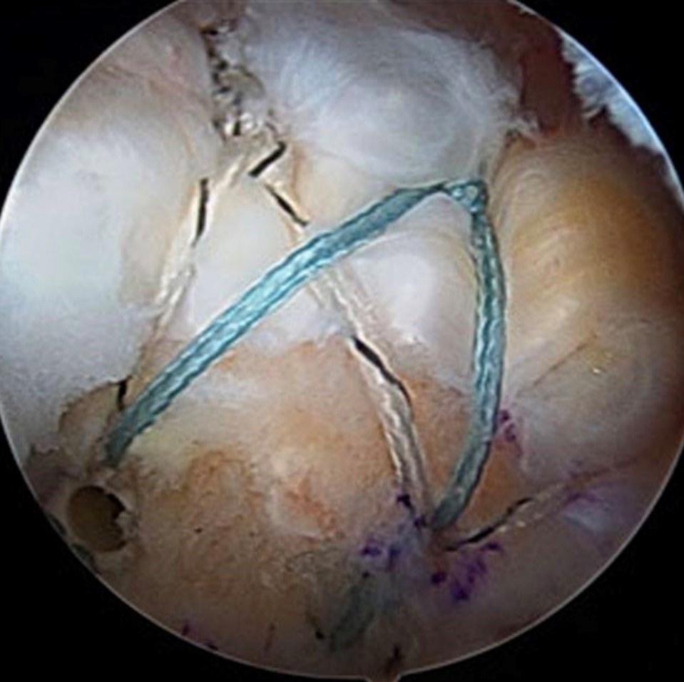 Khâu Rách Chóp Xoay Rách chóp xoay vai phẫu thuật nội soi khớp vai kỹ thuật Double-Row Trung tâm Chấn thương Chỉnh hình Khánh Hòa