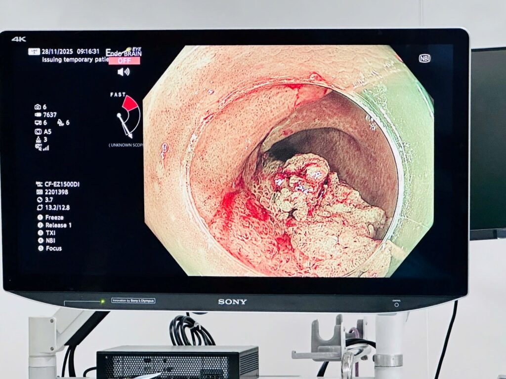 Kỹ thuật ESD Cắt bóc tách dưới niêm mạc qua nội soi điều trị ung thư sớm ESD dạ dày đại tràng nội soi tiêu hóa Khánh Hòa