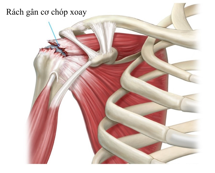 Khâu Rách Chóp Xoay Rách chóp xoay vai phẫu thuật nội soi khớp vai kỹ thuật Double-Row Trung tâm Chấn thương Chỉnh hình Khánh Hòa