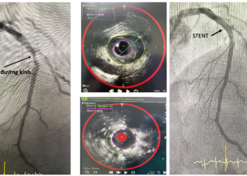 Ứng dụng NIRS–IVUS: Đột phá trong phát hiện sớm “mảng bám nguy hiểm” gây bệnh mạch vành