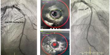 Ứng dụng NIRS–IVUS: Đột phá trong phát hiện sớm “mảng bám nguy hiểm” gây bệnh mạch vành