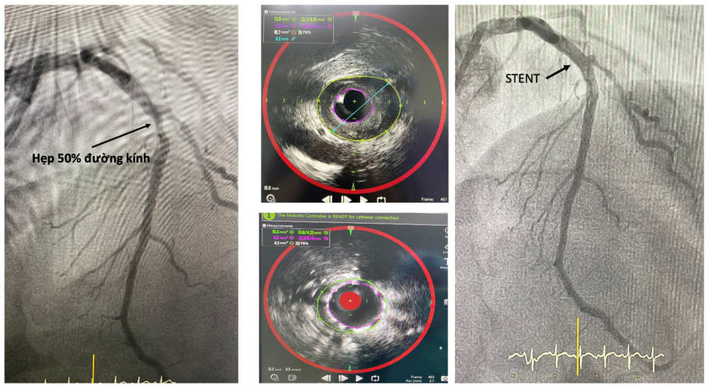 Kỹ thuật NIRS Siêu âm nội mạch IVUS bệnh mạch vành nhồi máu cơ tim tim mạch can thiệp Khánh Hòa mảng xơ vữa giàu lipid