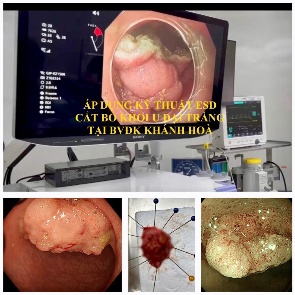 Kỹ thuật ESD Cắt bóc tách dưới niêm mạc qua nội soi điều trị ung thư sớm ESD dạ dày đại tràng nội soi tiêu hóa Khánh Hòa