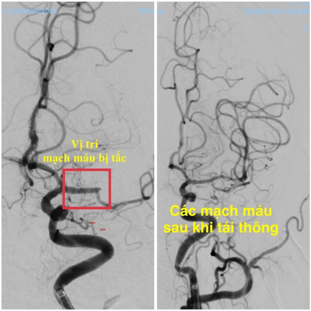 Cấp cứu đột quỵ lấy huyết khối cơ học thời gian vàng đột quỵ can thiệp mạch não Bệnh viện Đa khoa Khánh Hòa nhồi máu não cấp