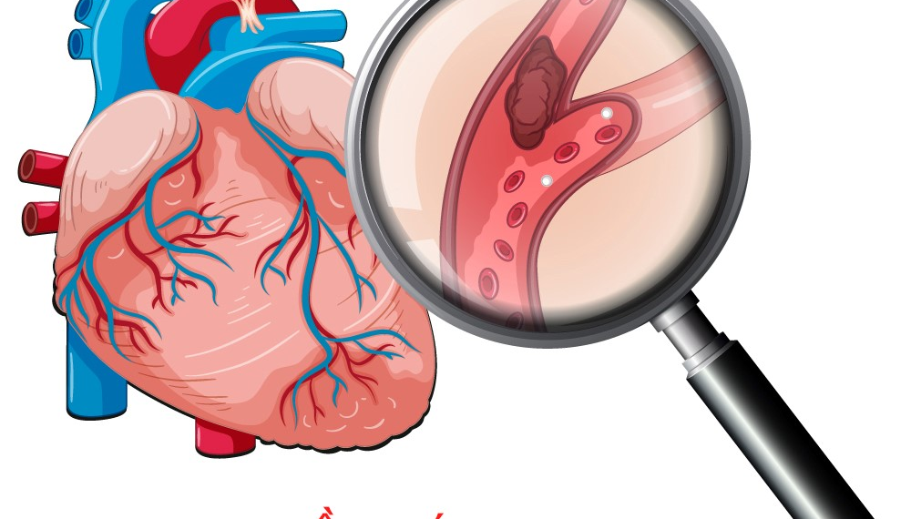 Nhồi máu cơ tim ở tuổi 23 Bệnh viện Đa khoa Khánh Hòa dấu hiệu nhồi máu cơ tim nguyên nhân nhồi máu cơ tim ở người trẻ phòng ngừa bệnh tim mạch